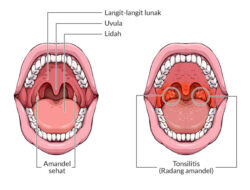 Fakta Medis Seputar Radang Amandel: Memahami Penyakit yang Sering Terjadi