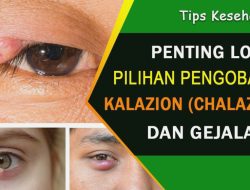 Cara Mengatasi Bintitan (Kalazion) yang Membandel Secara Natural