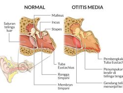 Memahami Kesehatan Telinga: Apa Perbedaan Otitis Media dan Otitis Eksterna?