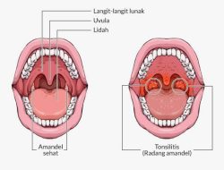 Memahami Kesehatan Tenggorokan: Perbedaan Radang Amandel dan Faringitis