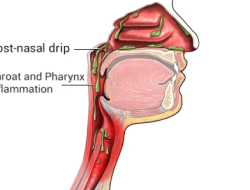 Mengapa Lendir Sering Menumpuk di Tenggorokan? Memahami Postnasal Drip, Penyebab, dan Cara Mengatasinya