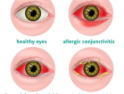 Panduan Kesehatan: Bagaimana Cara Membedakan Konjungtivitis Alergi dan Bakteri