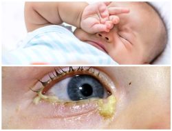 Panduan Lengkap: Bagaimana Cara Mengatasi Mata Merah (Belekan) pada Bayi secara Natural