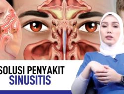 Panduan Lengkap: Bagaimana Cara Mengobati Sinusitis Kronis secara Alami dan Efektif