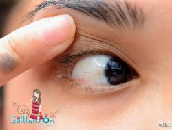Panduan Lengkap dan Aman: Bagaimana Cara Melepas Softlens yang Menempel pada Mata