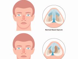 Panduan Medis: Cara Membedakan Deviasi Septum dan Rhinitis