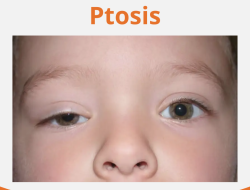Understanding Sudden Eyelid Drooping: Causes, Symptoms, and Medical Evaluation